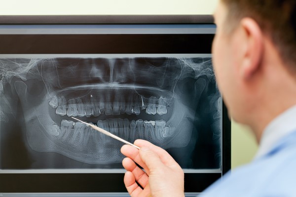 Is Bone Grafting Necessary For Dental Implants?