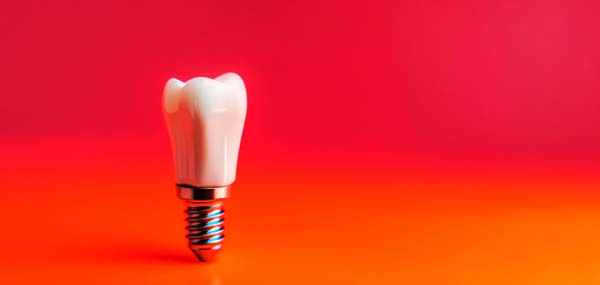 FAQs About Dental Implants