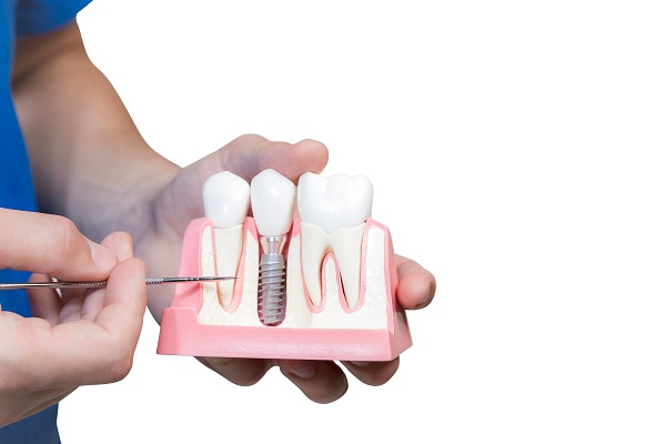Important Dental Implant Surgery Planning Tips
