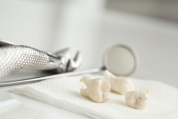 How A Wisdom Tooth Extraction Is Performed By An Oral Surgeon